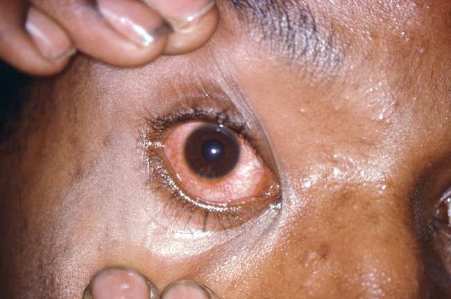 Konjungtivitis gonokokus mata kanan. Sumber: J Miller, PHIL CDC, 1976.