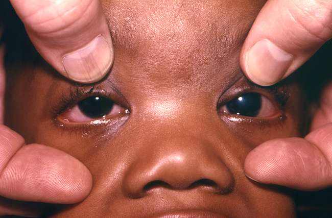 Glaukoma kongenital akibat rubella. Sumber: AJ Lebrun, PHIL CDC, 1969.
