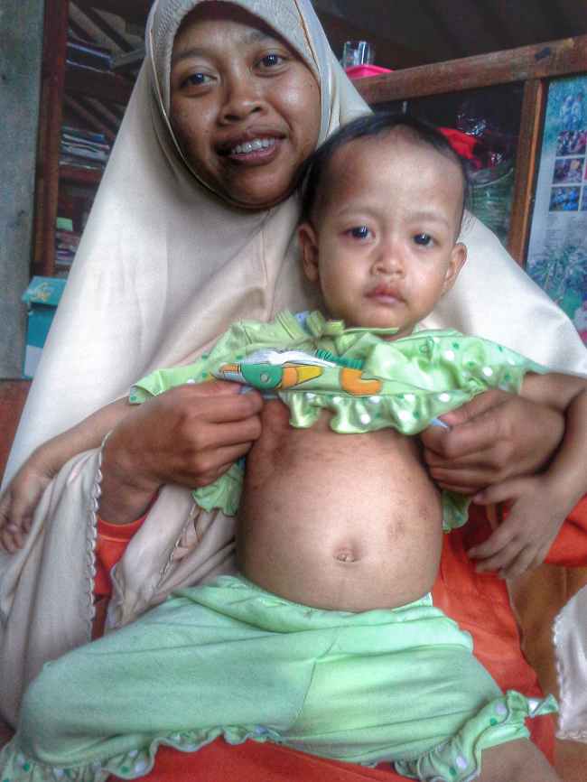 Anak di Sleman menderita campak akibat orang tua menolak vaksin karena pandangan vaksin haram. Sumber: Edy Purba, PHIL CDC, 2015.