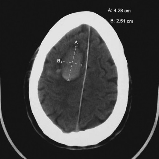 Stroke hemorrhagik subkortikal intraserebral. Sumber: anonim, Openi, 2010.