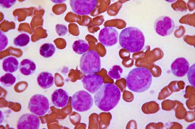 Leukemia adalah