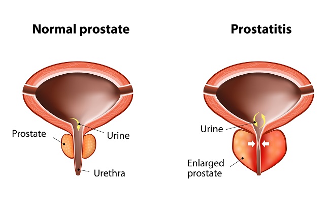 mert a betegség a prostatitis)