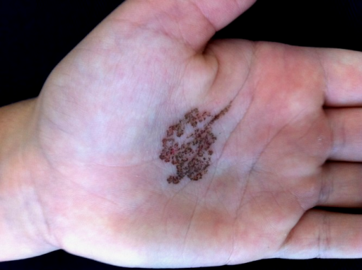 Tinea negri yang secara bentuk menyerupai melanoma. Sumber: Openi 2014.