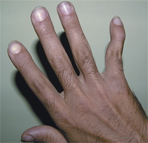Gambar: Deformitas swan neck pada digiti minimi. Sumber: anonim, Openi, 2012.