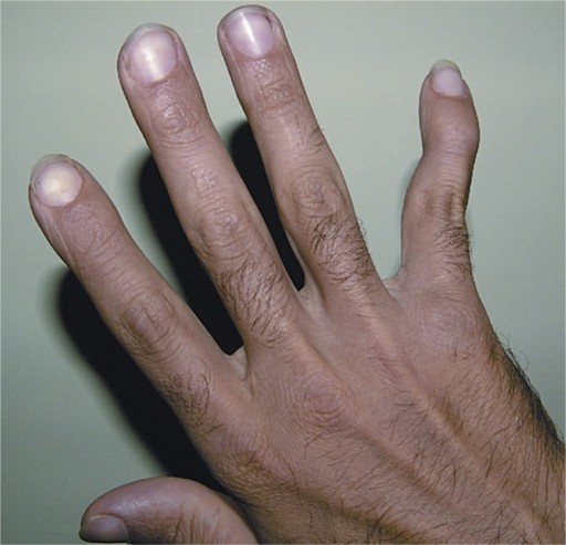 Adalah artritis Gout Arthritis: