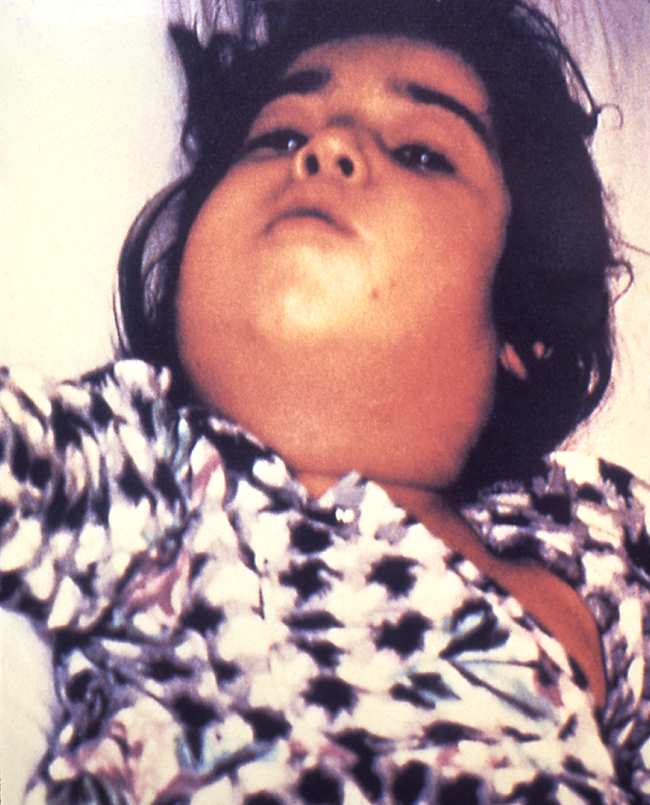 Sumber: anonim, PHIL CDC, 1995.
