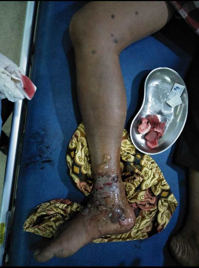 Gambar 2 Gigitan ular berat: fang marks, bula, perdarahan spontan dari luka, edema lokal dengan sindrom kompartemen. (source: koleksi pribadi dr.debtia)