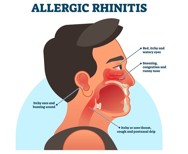 Rhinitis Alergi - patofisiologi, diagnosis, penatalaksanaan - Alomedika