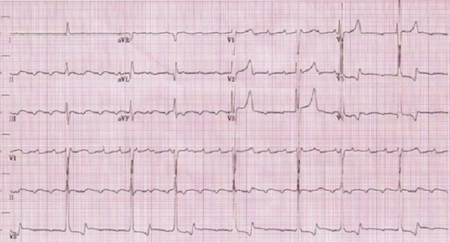 Gambar 2. Gambaran EKG atrial flutter. Sumber : Openi, 2009