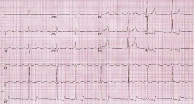 Gambar 2. Gambaran EKG atrial flutter. Sumber : Openi, 2009
