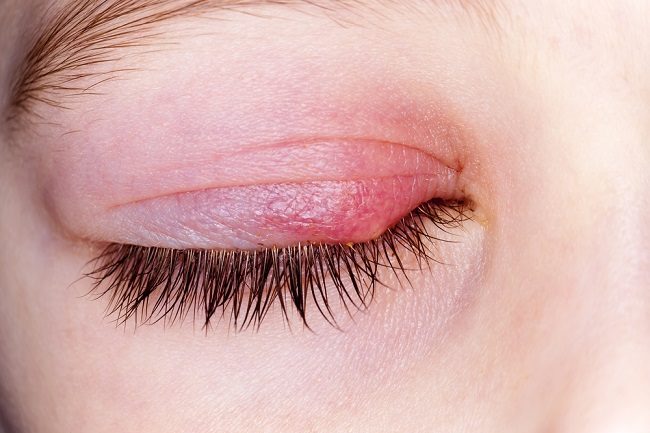 6 Penyebab Mata Bengkak Tiba Tiba Ketika Bangun Tidur