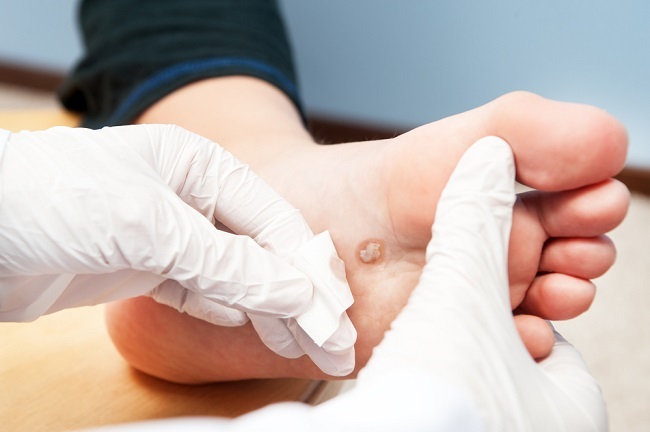 papilloma virus verruche cure)