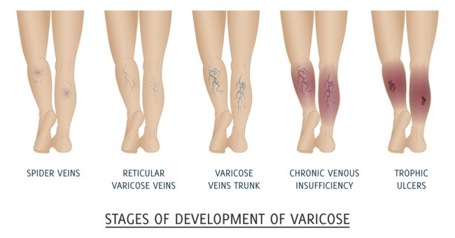 Simptomele edemului în varicoză - Edeme varicoase