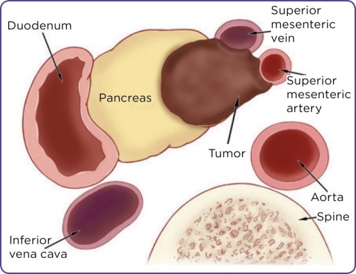 Karsinoma Pankreas tipe Borderline Resectable. Sumber: Openi, 2008