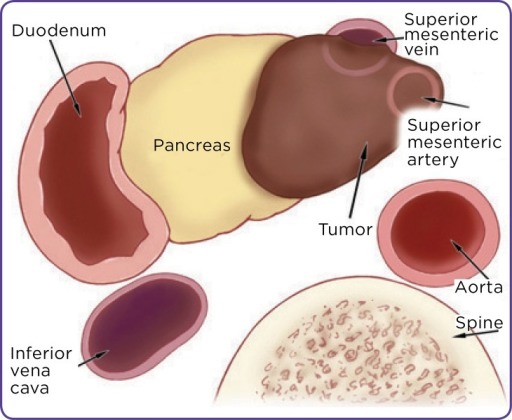 Karsinoma Pankreas tipe Locally Advanced. Sumber: Openi, 2008