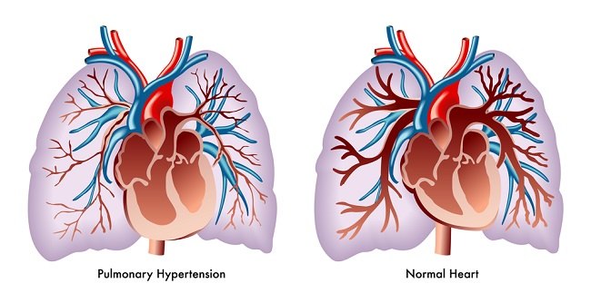 a pulmonalis hipertónia okai