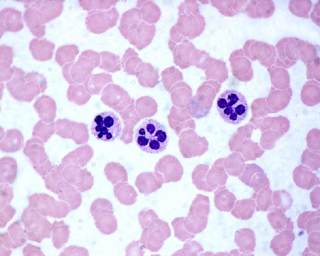Anemia Megaloblastik Patofisiologi Diagnosis Penatalaksanaan Alomedika