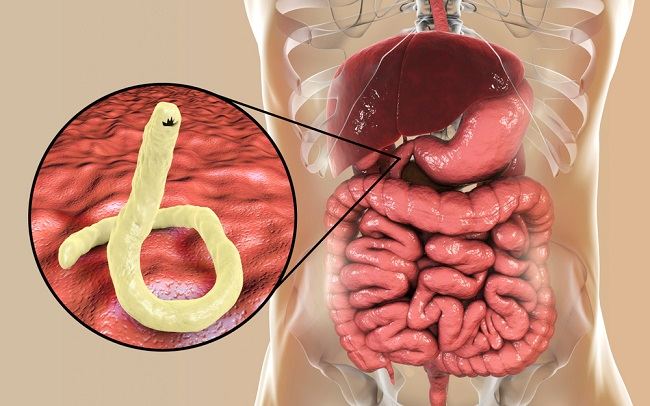 ankilostomiasis jelek