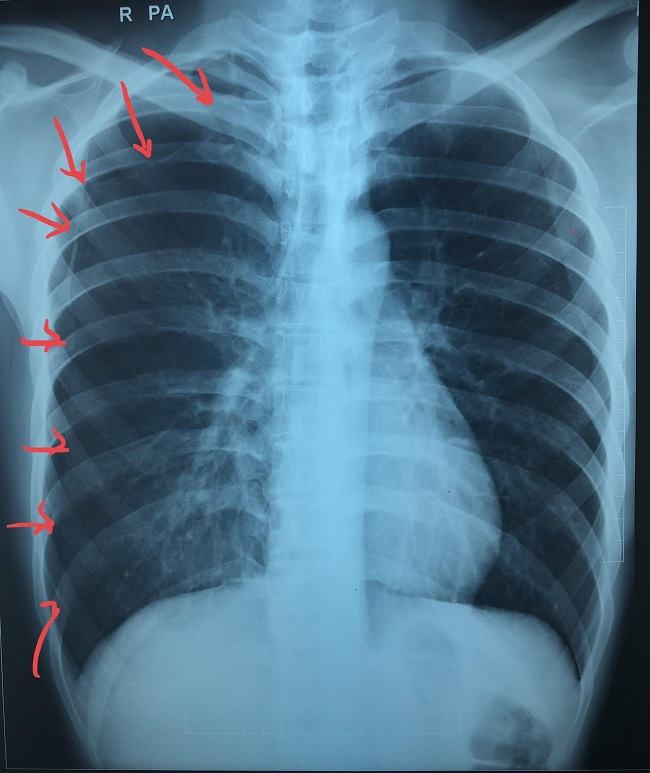 Penggunaan Chest  Tube Drainage VS Aspirasi Jarum Pada 