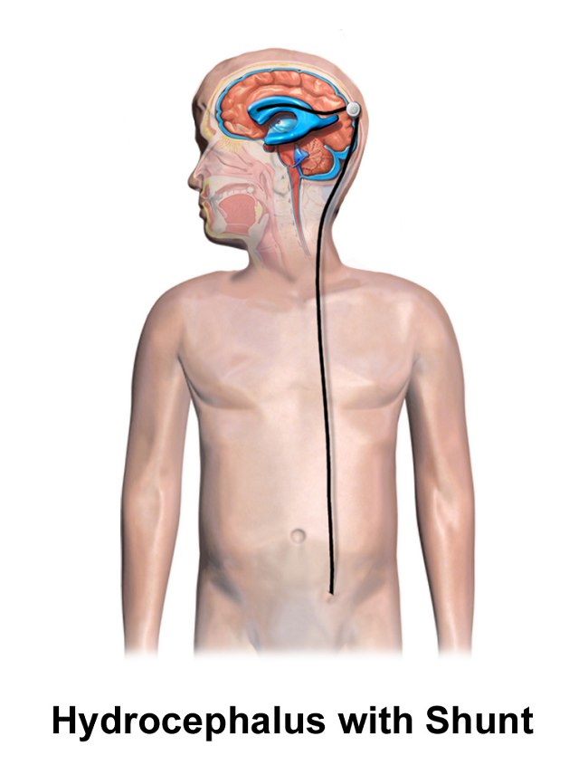 Penatalaksanaan Hydrocephalus Alomedika