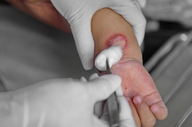 Silver Dressing Untuk Tata Laksana Rawat Jalan Pada Luka Bakar Anak Alomedika Silver Dressing Untuk Tata Laksana Rawat Jalan Pada Luka Bakar Anak Alomedika