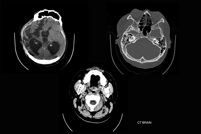 Gambar 3. Penegakkan diagnosis hidrosefalus dengan pemeriksaan CT Scan kepala