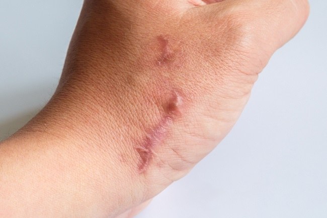 Parut Hipertrofik - Patofisiologi Diagnosis Penatalaksanaan - Alomedika Parut Hipertrofik - Patofisiologi Diagnosis Penatalaksanaan - Alomedika