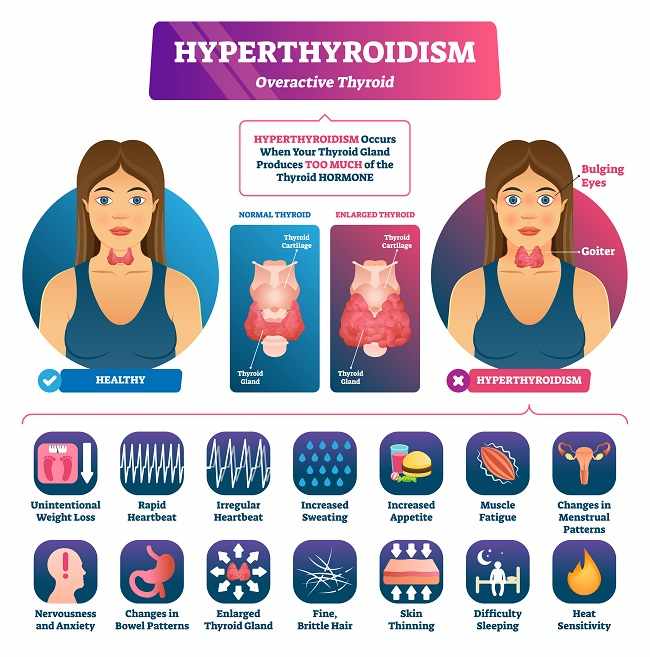  Hipertiroid  patofisiologi diagnosis penatalaksanaan 