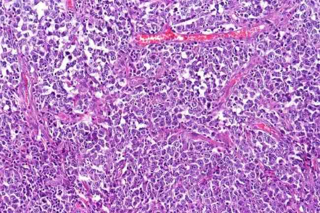 Limfoma Non Hodgkin Patofisiologi Diagnosis Penatalaksanaan Alomedika
