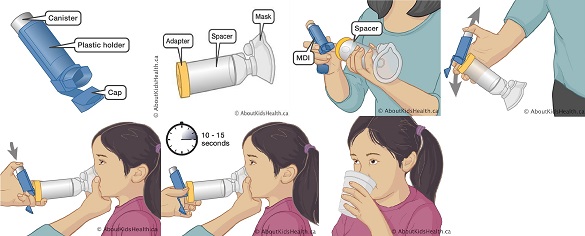  Terapi  Inhalasi Nebulizer Vs MDI Spacer Sebagai Terapi  