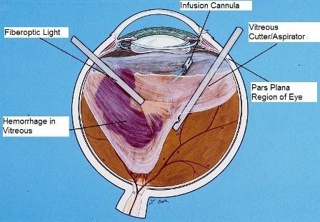 Teknik Vitrektomi Alomedika