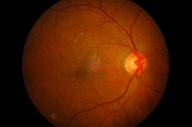 Ангиопатия сосудов сетчатки что это. Гипертоническая ретинопатия. Гипертоническая ангиопатия и ретинопатия. Гипертоническая ретинопатия глазное дно. Почечная ретинопатия сетчатки.