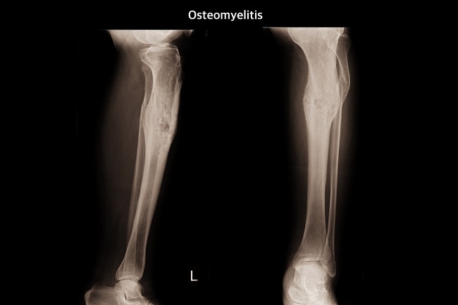 Osteomyelitis Patofisiologi Diagnosis Penatalaksanaan Alomedika