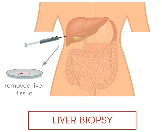 Biopsi adalah