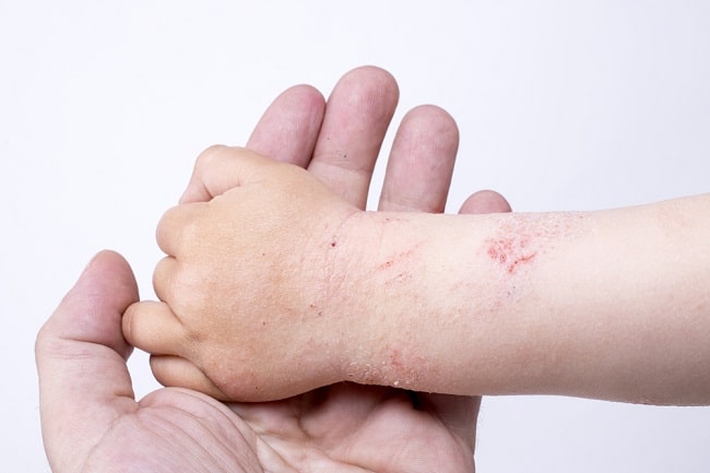 kenőcs pikkelysömör dermatitis ekcma vörös foltok a férfiak között a lábak között