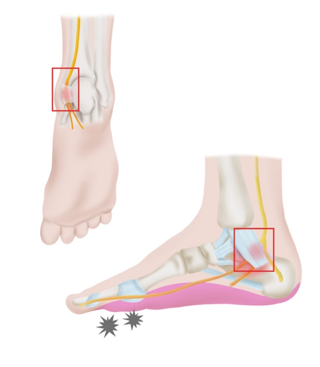  Tarsal  Tunnel Syndrome patofisiologi diagnosis 