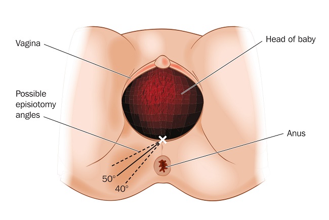 Episiotomi - patofisiologi, diagnosis, penatalaksanaan - Alomedika