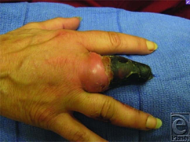 Gambar Golongan Darah Laporan praktikum golongan darah