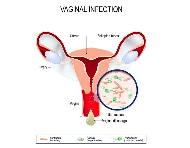 Vaginitis - patofisiologi, diagnosis, penatalaksanaan - Alomedika