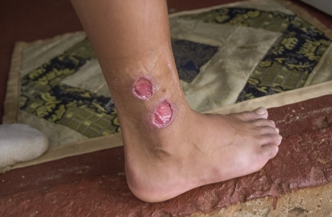 poze cu paraziti leishmania