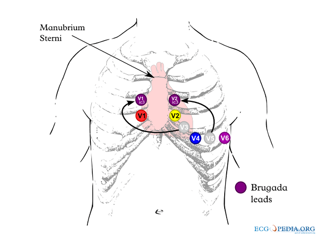  Gambar 2. Pemasangan Lead EKG untuk Diagnosis Sindrom Brugada. Sumber Gambar: CardioNetworks, Wikimedia Commons, 2012.