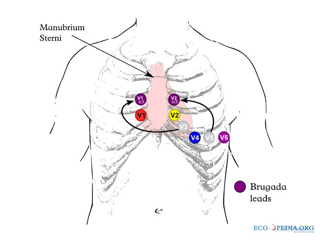 Gambar 2. Pemasangan Lead EKG untuk Diagnosis Sindrom Brugada. Sumber Gambar: CardioNetworks, Wikimedia Commons, 2012.