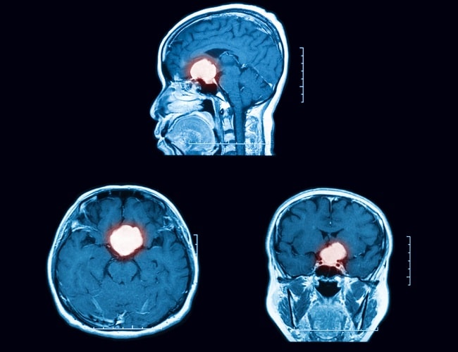 Adenoma hipofisis adalah